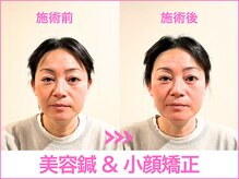 A1スポーツマッサージ治療院/【ビフォーアフター】美容鍼