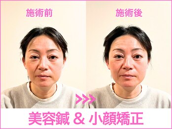 A1スポーツマッサージ治療院/【ビフォーアフター】美容鍼