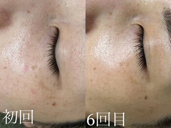 サロンドジェシカ(salon de Jessica)/プラズマフェイシャル