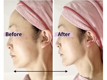 マリア(MALIA)/横顔が変わる小顔