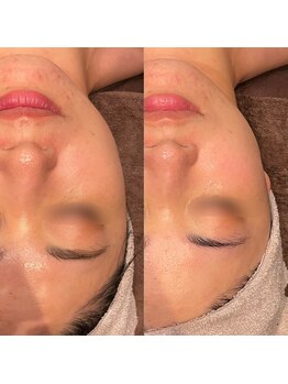 ビュウナ 銀座(BEAUNA)/マルチウェーブリフト