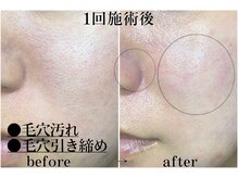 リーインカーナ アーティスト(REINCARNA ARTIST)の雰囲気(毛穴/黒ずみ/角栓除去【一回で効果実証】ハイドラ吸引→¥4000)