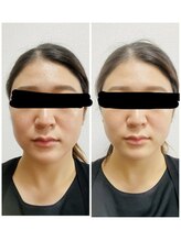 うつくし痩身 美サロン ゼットワン(Z-ONE)/before　after