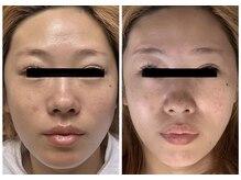 リコ(Relaxation Boutique LICO)/オーダーメイドフェイシャル