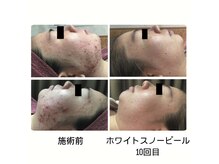 メット(met)の雰囲気（肌質改善に効果的）