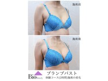 バイオビューティー 神戸本店(Bio Beauty)/プランプバスト　体験コース症例