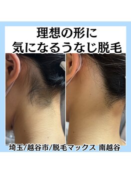脱毛マックス 南越谷店(MAX)/レディース[うなじ脱毛]
