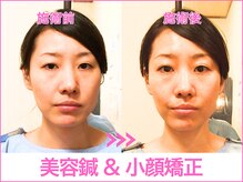 A1スポーツマッサージ治療院/【ビフォーアフター】美容鍼