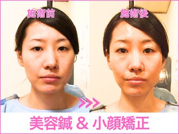 A1スポーツマッサージ治療院/【ビフォーアフター】美容鍼