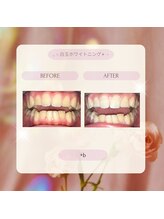 プラスビー 2号店(+b)/ホワイトニングビフォーアフター