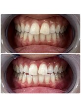 エクシアホワイトニング 日本橋店/人形町ホワイトニング