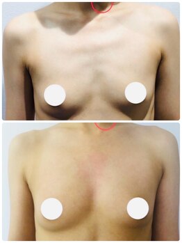 オリーブ 金沢(Olive)/バストアップ★育乳症例