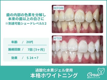 クレア(Crea)/【ホワイトニング症例写真】