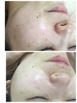 メイユール(MEILLEUR)/光フェイシャル6回