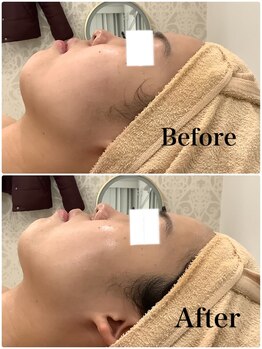 スペチアーレ 夙川/小顔と美肌で無敵の美顔