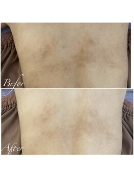 アトリエリン 小牧本店(Atelier Rin)/背中の色素沈着