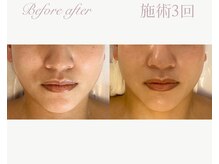 パルタージュ(Partage)/剥離なし！プレハーブピーリング