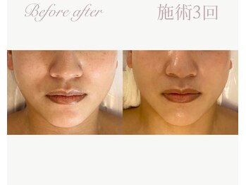 パルタージュ(Partage)/剥離なし！プレハーブピーリング