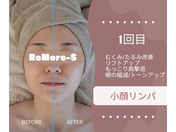 りもあず(ReMore-S)/裏人気MENU/えら張りを取りたい