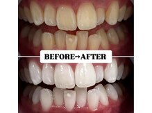 ホワイトニングサロン 豊中/Before&After美白ホワイトニング