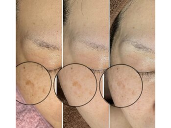 リリー(RILY)/【プラズマビフォーアフター】