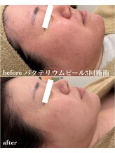 てづか整骨院 西都院/バクテリウムピール