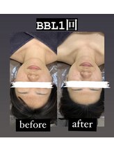 ホッコリ 段原店(HOKKORI)/効果実感No.1BBL光フェイシャル