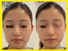 ヴィオール 名古屋栄店(VIOR)/レモンボトル　塗布直後