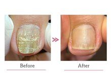 Sisters Nail & 巻き爪Compass/巻き爪/変形爪