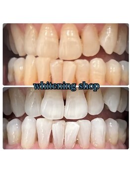 ホワイトニングショップ 池田店/【BEFORE/AFTER】