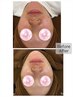 【繰り返すニキビ・赤みに】ハーブピーリング+再生因子+生酵素 ¥14,000