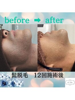 ラ フェリーチェ(La Felice)/ひげ脱毛Before　Afteｒ（1）