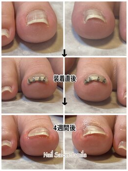 ジャミーラ(Jamila)/巻き爪矯正