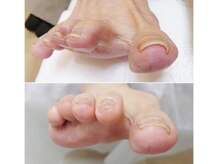 リゼラアンドコー 布施店/巻き爪ケア！