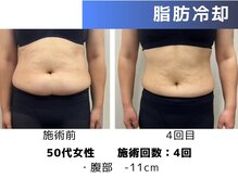 エープラス(A+)/脂肪冷却