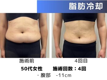 エープラス(A+)/脂肪冷却