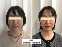ナチュレアンドメディカ(Nature&Medica)/【たるみor小顔】ウルトラリフト