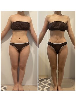 ヴィクシア(VIXIA)/痩身90分