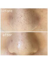 スムース(SMOOTH)/お鼻の黒ずみ　板橋/高島平/西台