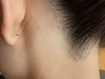 オアシスラグーン(OASIS LAGOON)/うなじ脱毛(症例2:after)