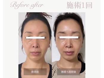 パルタージュ(Partage)/剥離なし！プレハーブピーリング