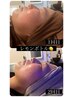 韓国肌管理【脂肪分解レモンボトル】2cc¥24800→¥14800