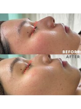 エムアイ 六本木(Mi)/やればやるほど強い肌に！！