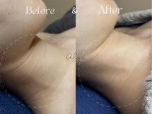 アイシス(AIsis)/首のシワ【5ヶ月】