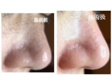 ミント/鼻のきわ、は一番つまりが多い