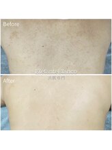 エレファンテブランコ(Elefante Blanco)/☆背中ニキビ/シミ＆毛孔苔癬