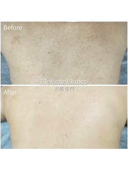 エレファンテブランコ(Elefante Blanco)/☆背中ニキビ/シミ＆毛孔苔癬