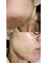 ナチュリー(Naturry)/私も肌トラブルで悩んでいました