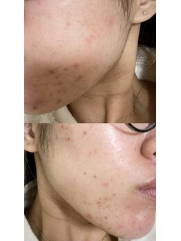 ナチュリー(Naturry)/私も肌トラブルで悩んでいました