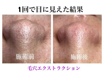 ビューティーネイル(Beauty Nail)/毛穴エクストラクション